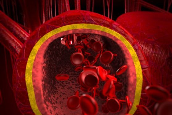 Tumors of the Blood Veins