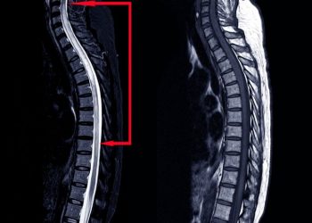 Spine Tumors Symptoms