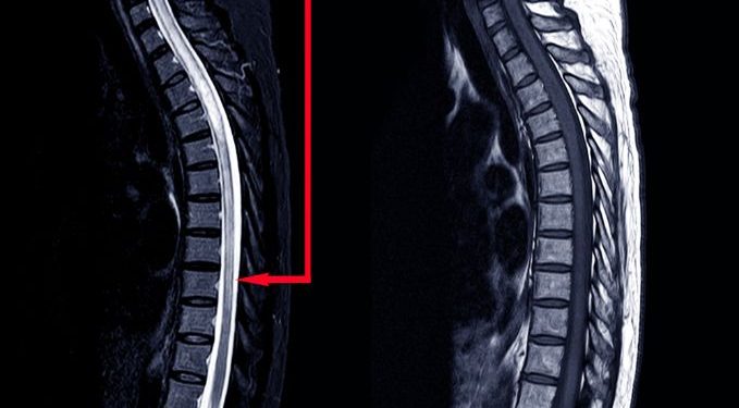 Spine Tumors Symptoms