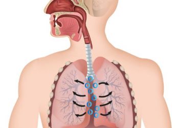 Mediastinal Tumors Symptoms and Treatment