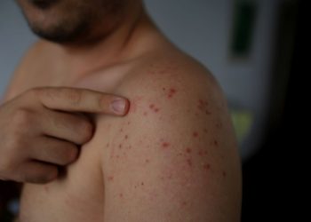 Erythema Nodosum Treatment