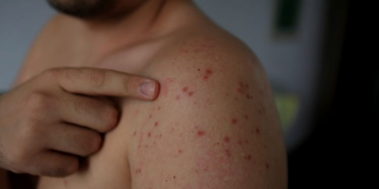 Erythema Nodosum Treatment