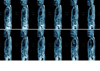 Bone Metastases Symptoms