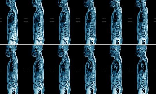 Bone Metastases Symptoms