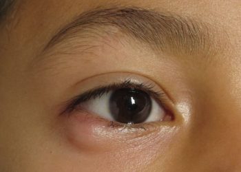 What Are the Symptoms of Papilledema?