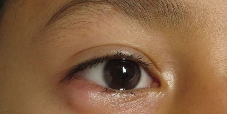 What Are the Symptoms of Papilledema?