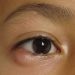What Are the Symptoms of Papilledema?