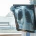 Getting a Handle on Asthma Symptoms