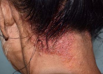Tinea Capitis Symptoms and Treatment