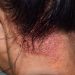 Tinea Capitis Symptoms and Treatment