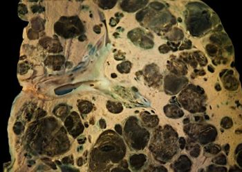 Cancer Metastases Symptoms