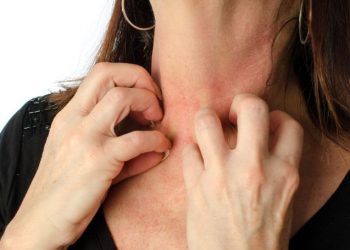 Eczema Symptoms and Treatment