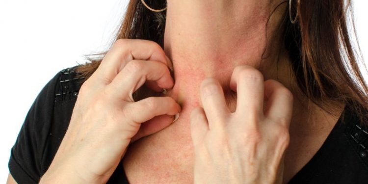Eczema Symptoms and Treatment