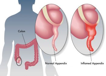 Acute Appendicitis Symptoms