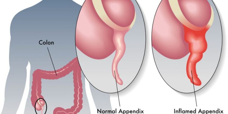 Acute Appendicitis Symptoms