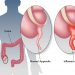 Acute Appendicitis Symptoms