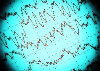 How to Recognize Epilepsy Symptoms