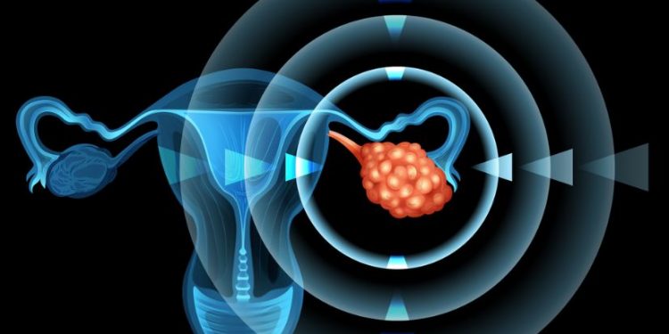 Malignant Ovarian Tumors