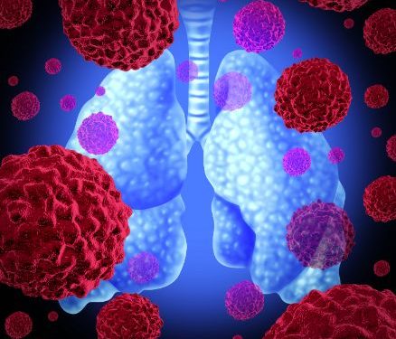 Benign Tumors of the Lung Symptoms and Treatment