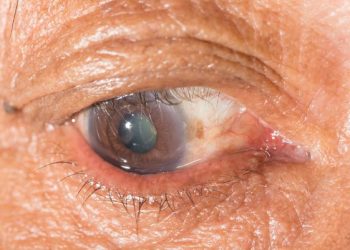 Trachoma Symptoms
