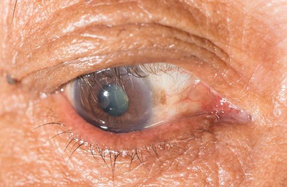 Trachoma Symptoms