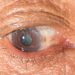 Trachoma Symptoms