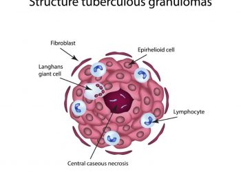 Tuberculous Meningitis Symptoms and Diagnosis