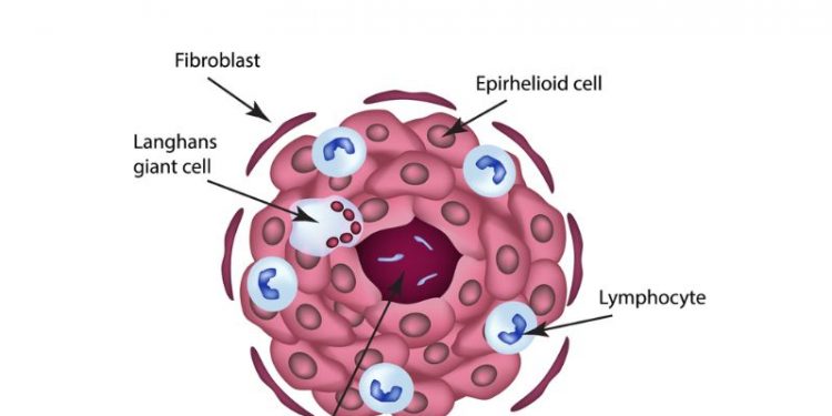 Tuberculous Meningitis Symptoms and Diagnosis