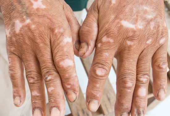 What Are Contact Dermatitis Symptoms?