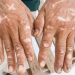 What Are Contact Dermatitis Symptoms?