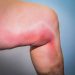 Phlebitis Symptoms