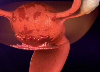 Vulvar Vestibulilitis