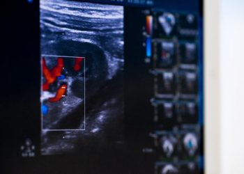 Mitral Valve Stenosis