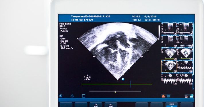 Tricuspid Stenosis