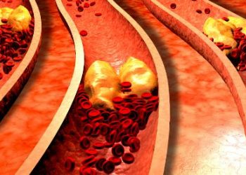 Familial Hypercholesterolemia Symptoms