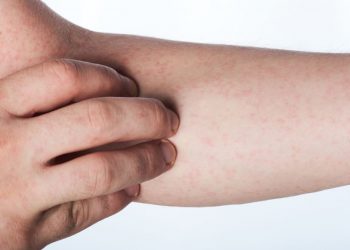 Vasculitides Symptoms