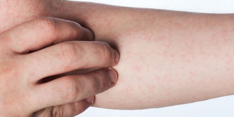 Vasculitides Symptoms