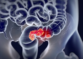 Achlorhydria Symptoms