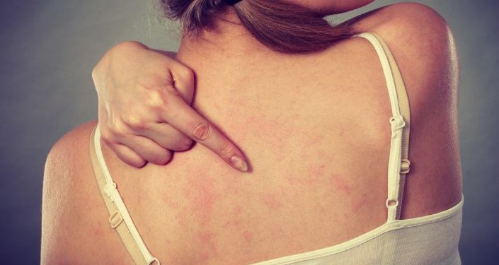 Dermatitis Symptoms and Treatment