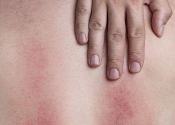 Hypothermia Symptoms