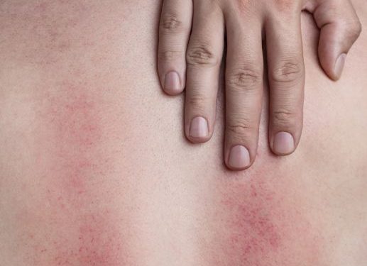 Hypothermia Symptoms