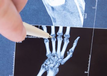 Juvenile Rheumatoid Arthritis
