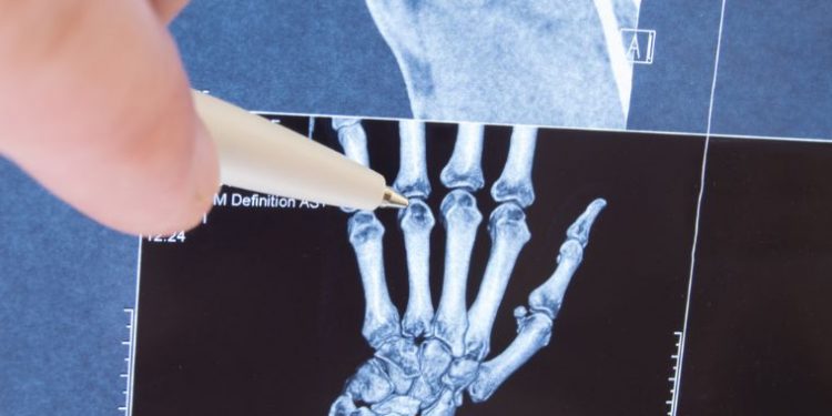 Juvenile Rheumatoid Arthritis