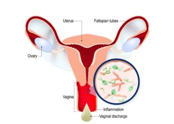 Vaginitis Symptoms