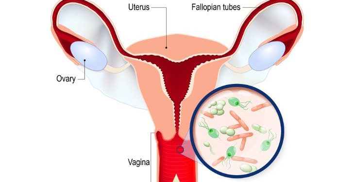 Vaginitis Symptoms