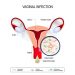 Vaginitis Symptoms
