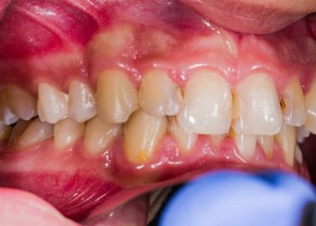 Periadenitis Symptoms