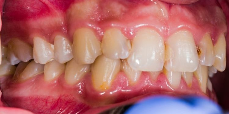 Periadenitis Symptoms