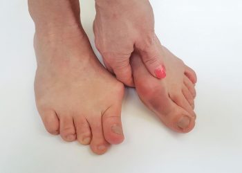 Hallux Valgus Symptoms