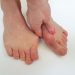 Hallux Valgus Symptoms